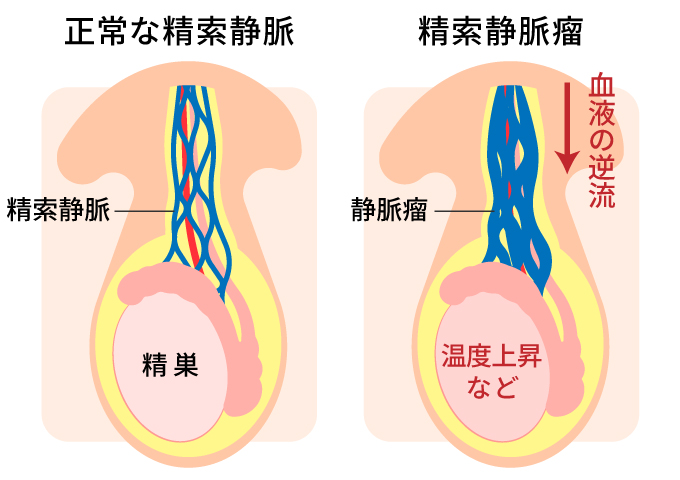 精索静脈瘤